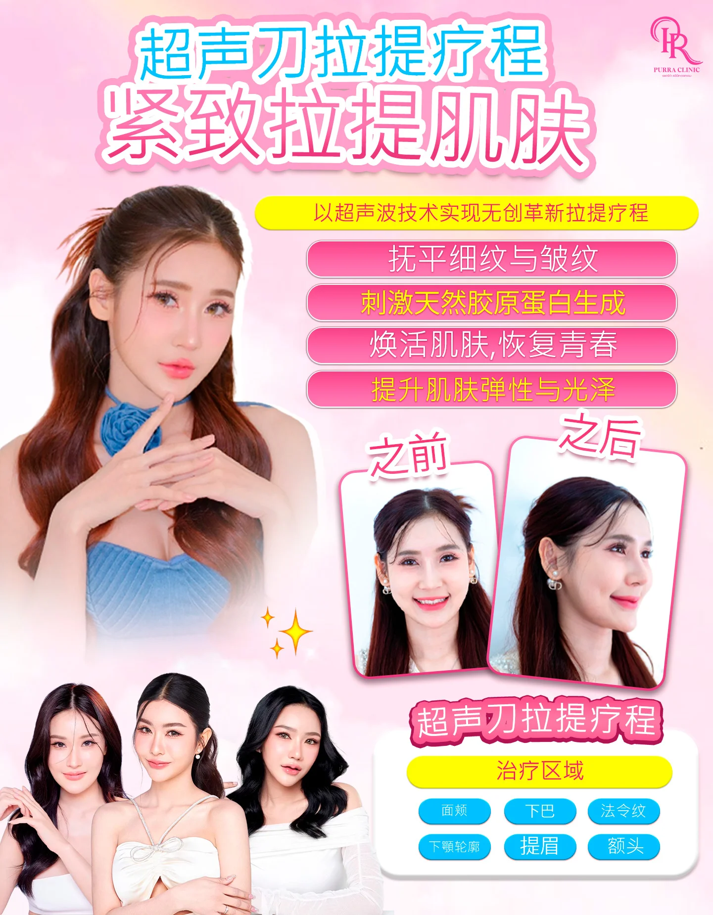 Ultraformer超声波提拉