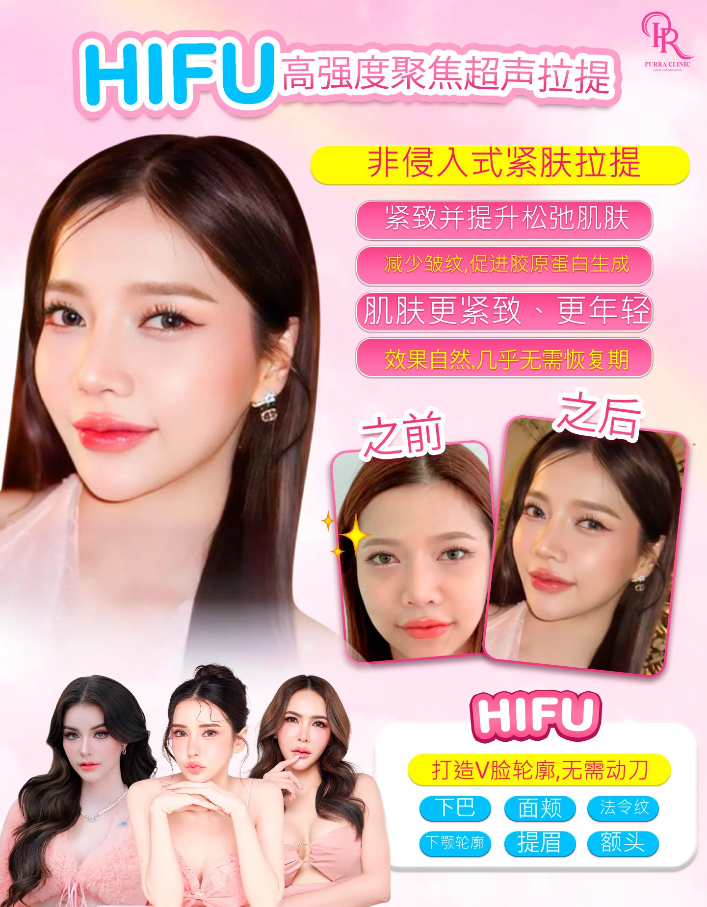 高强聚焦超声提拉（HIFU）