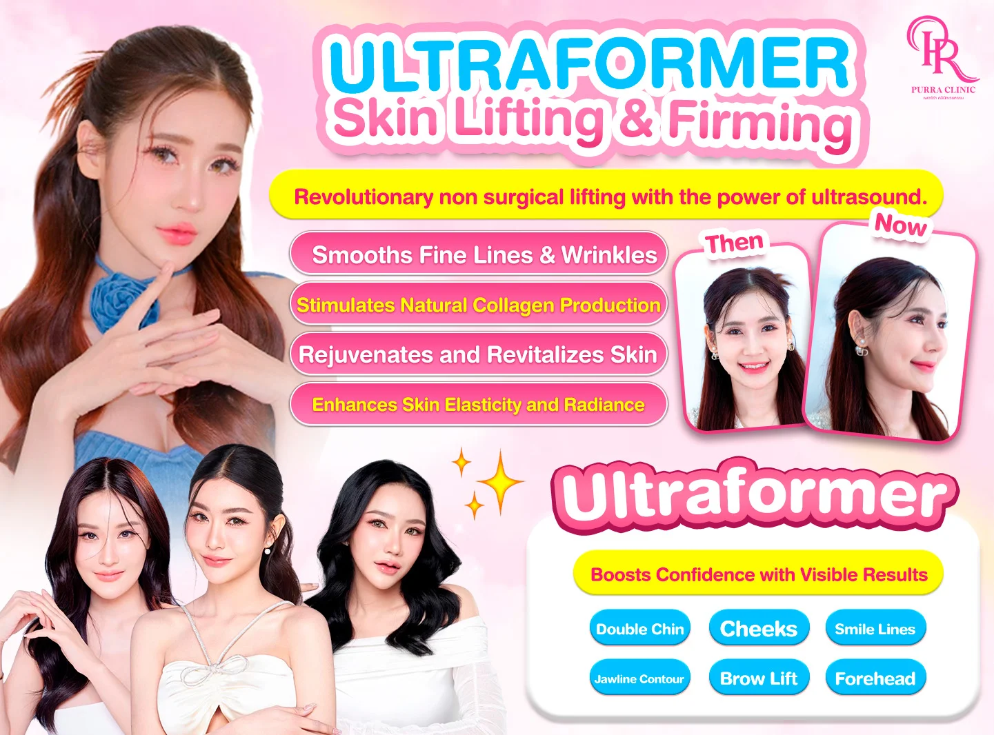 Ultraformer