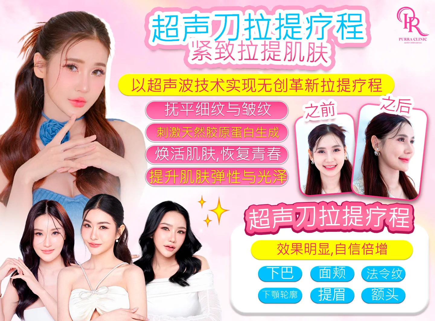 Ultraformer超声波提拉