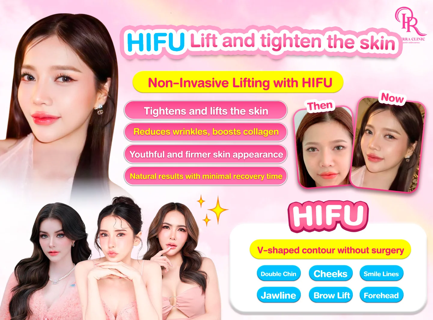 HIFU