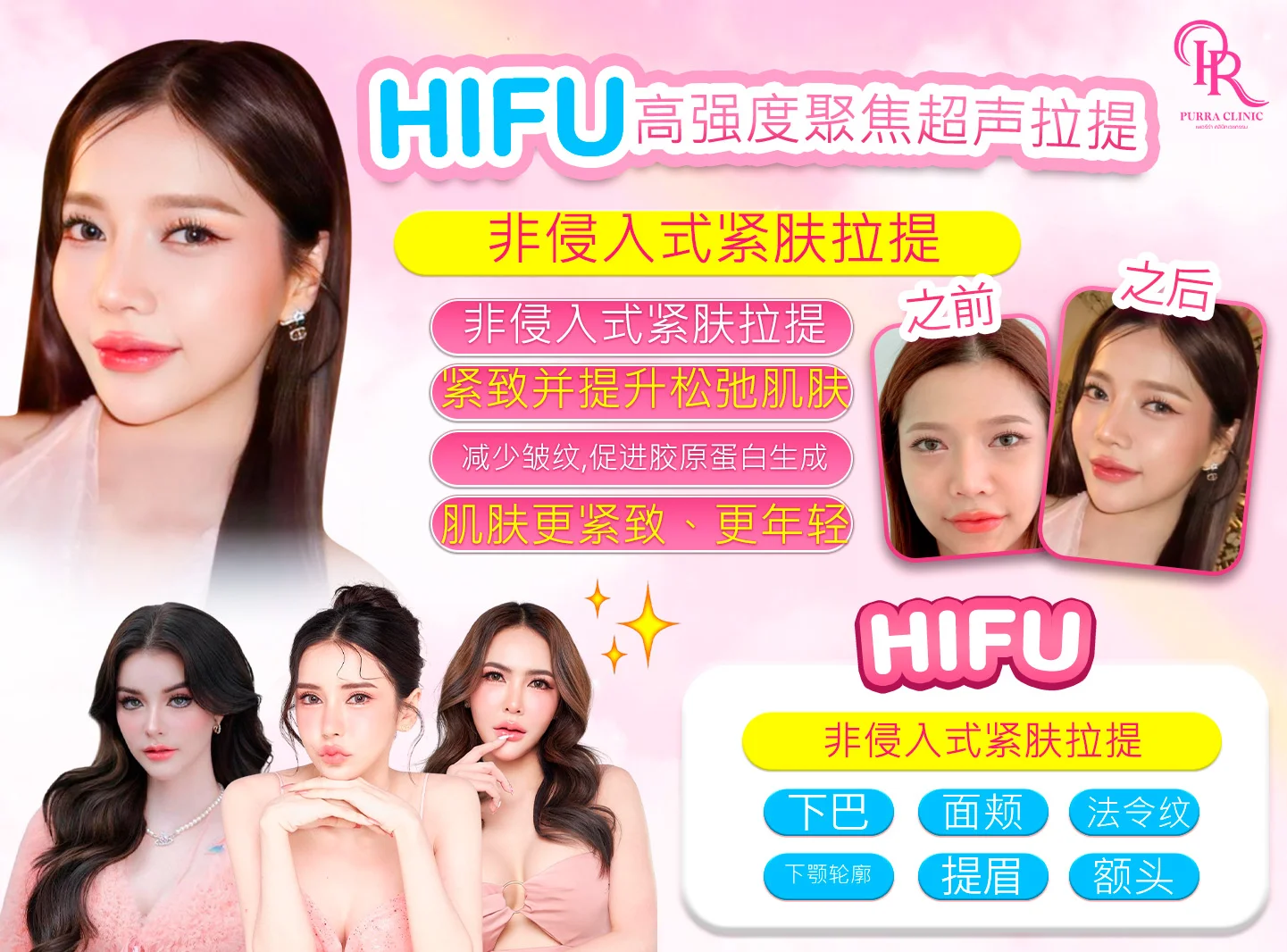 高强聚焦超声提拉（HIFU）