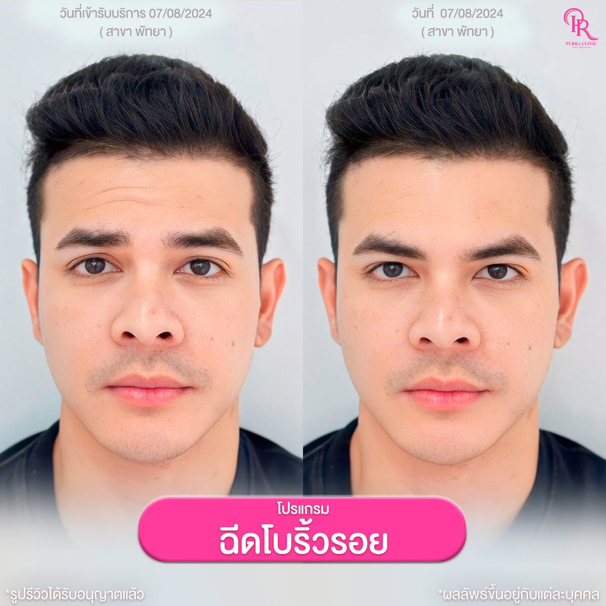Potram Injection Anti-Wrinkle Program - Purra Clinic