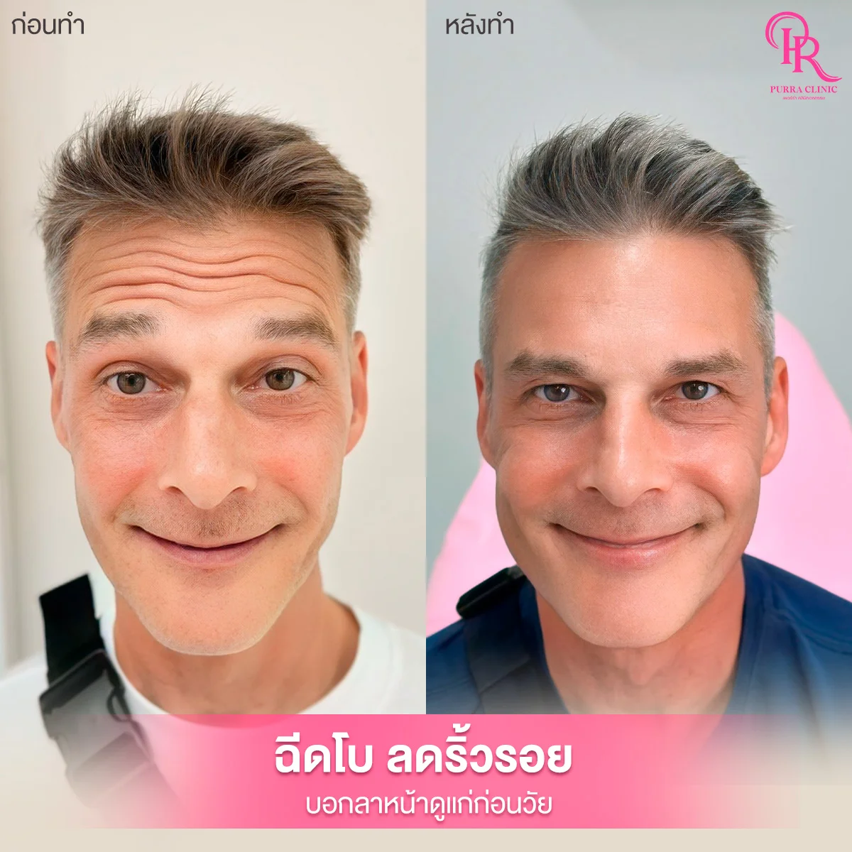 รีวิวโบท็อกซ์ลดริ้วรอย