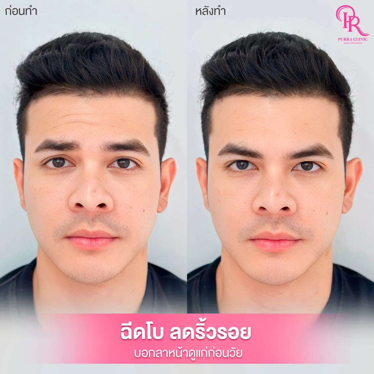 รีวิวโบท็อกซ์ลดริ้วรอย
