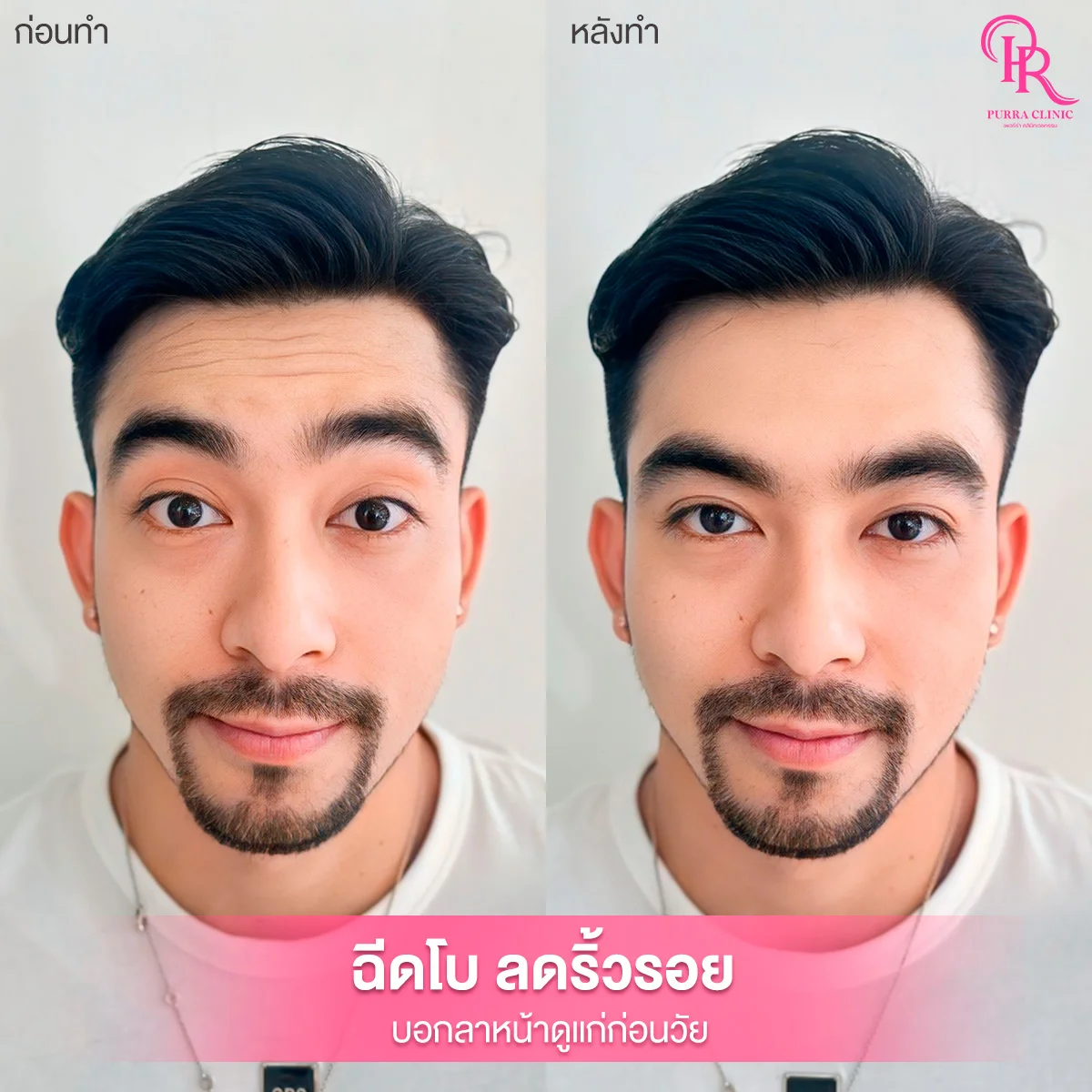 รีวิวโบท็อกซ์ลดริ้วรอย