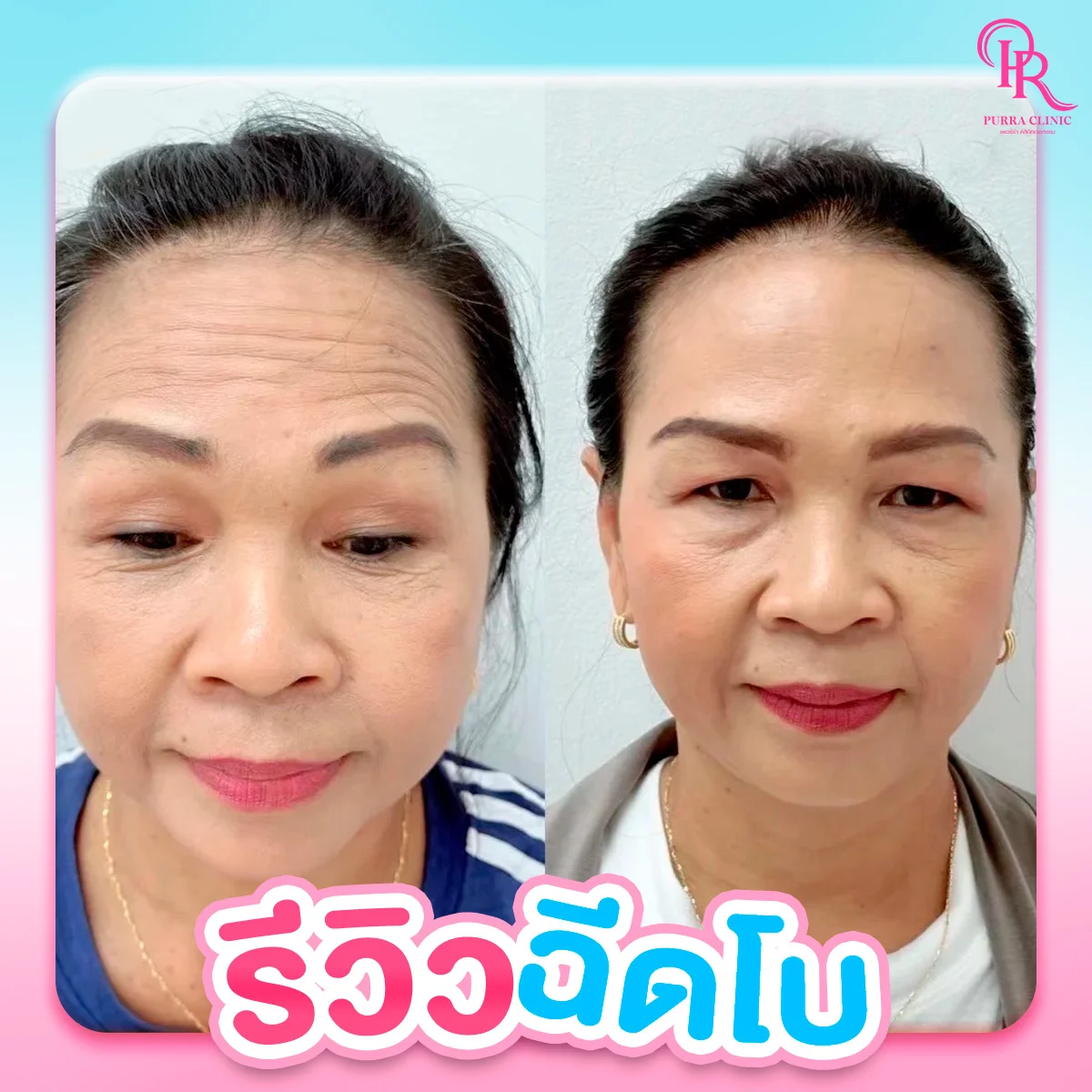 รีวิวโบท็อกซ์ลดริ้วรอย