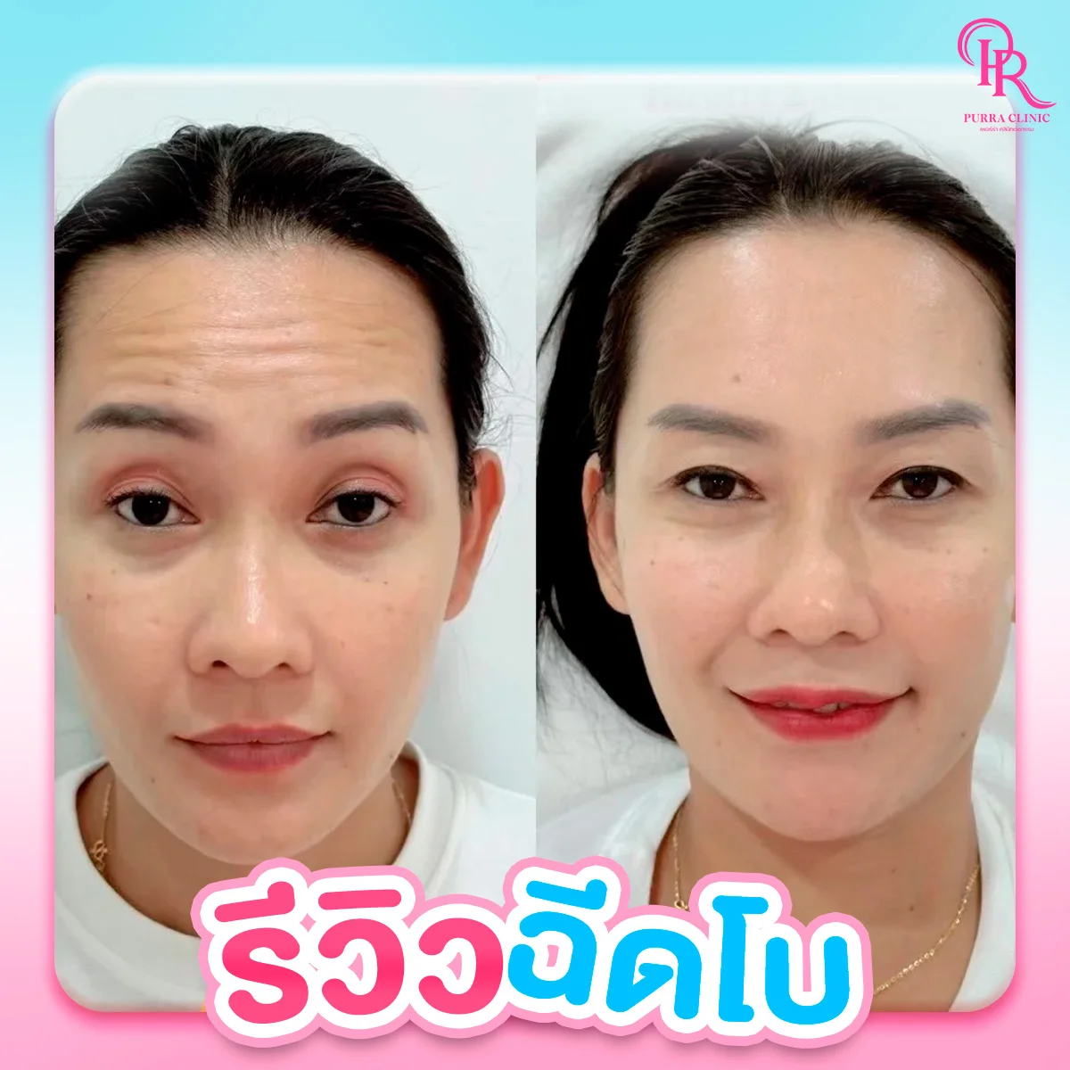 รีวิวโบท็อกซ์ลดริ้วรอย