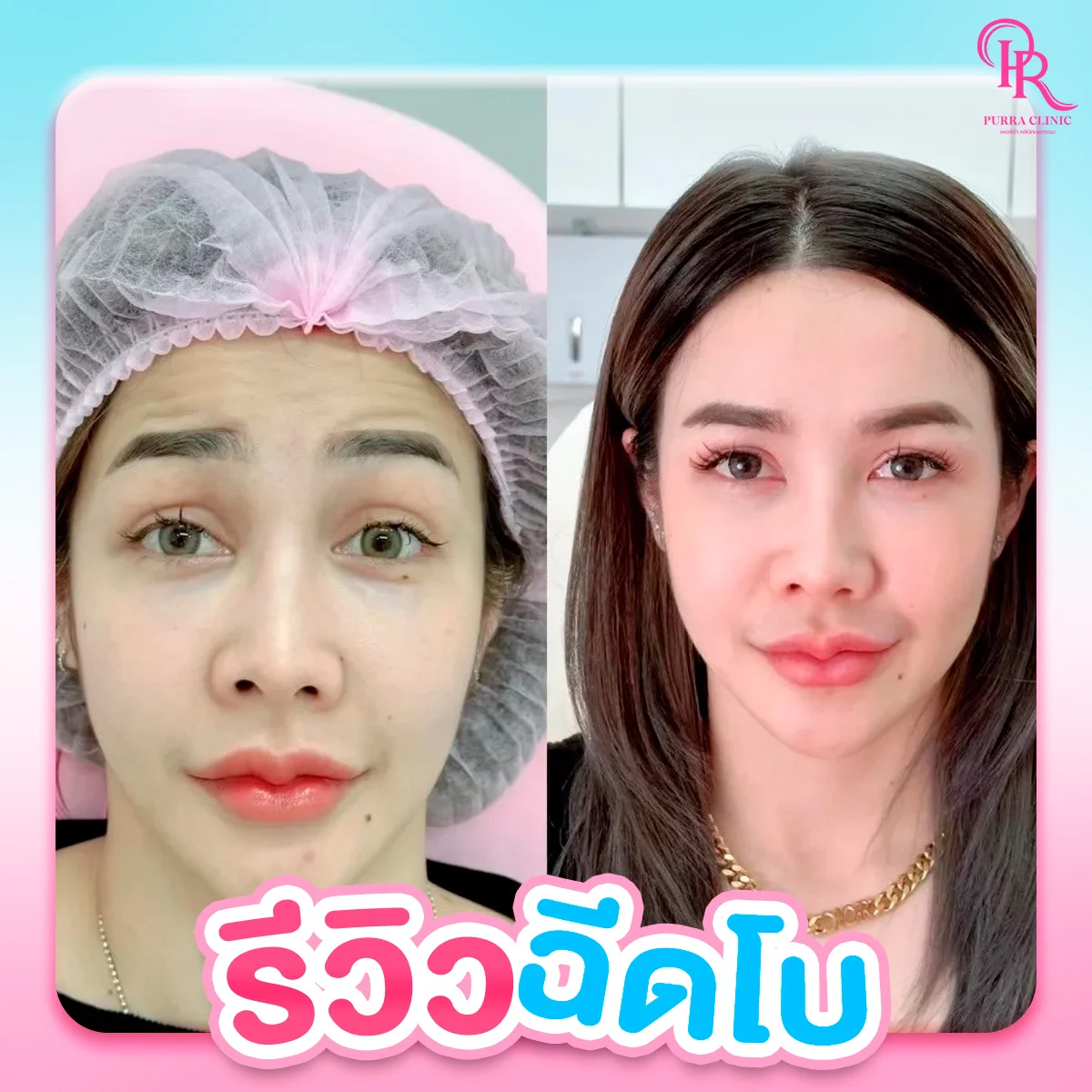 รีวิวโบท็อกซ์ลดริ้วรอย