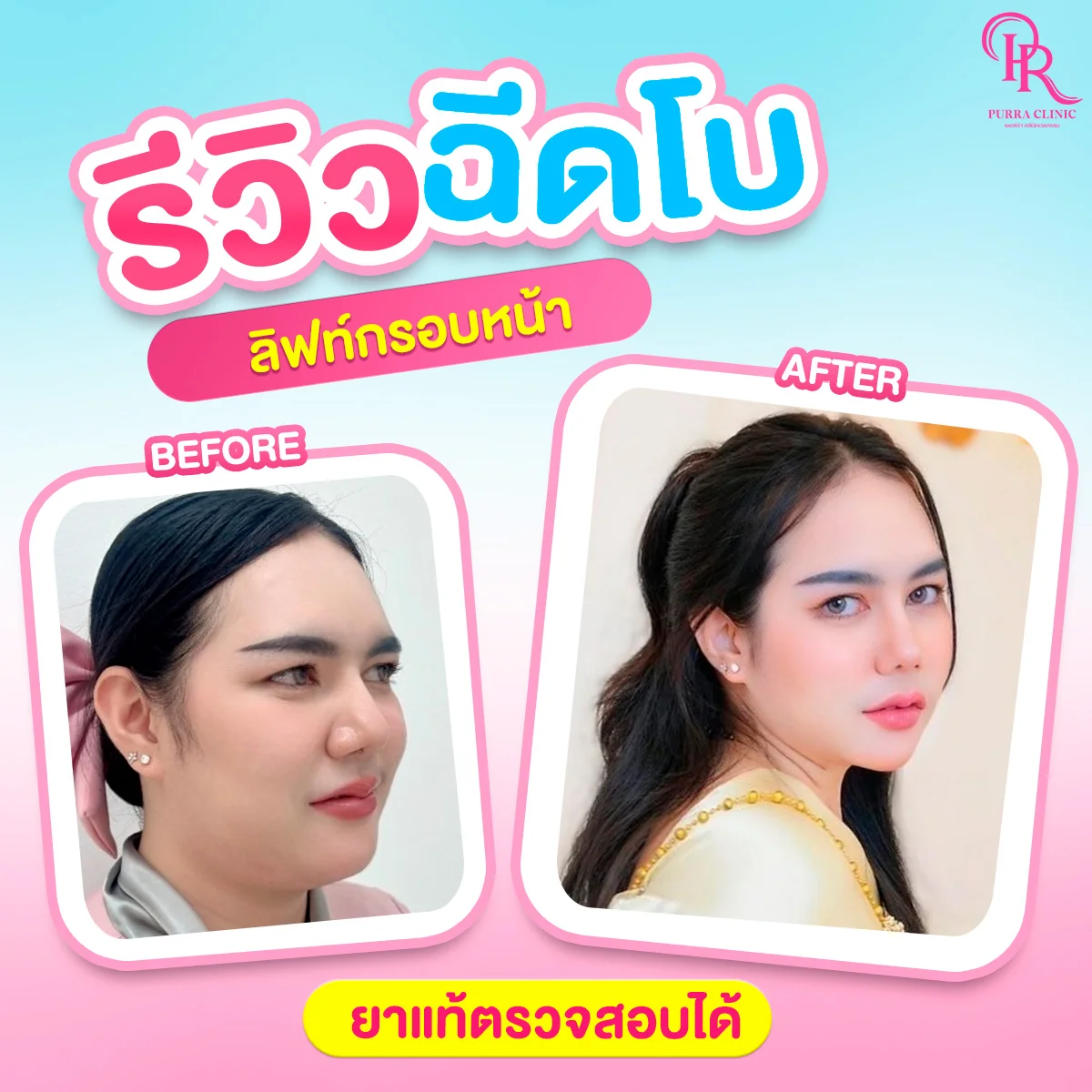 รีวิวลิฟกรอบหน้า