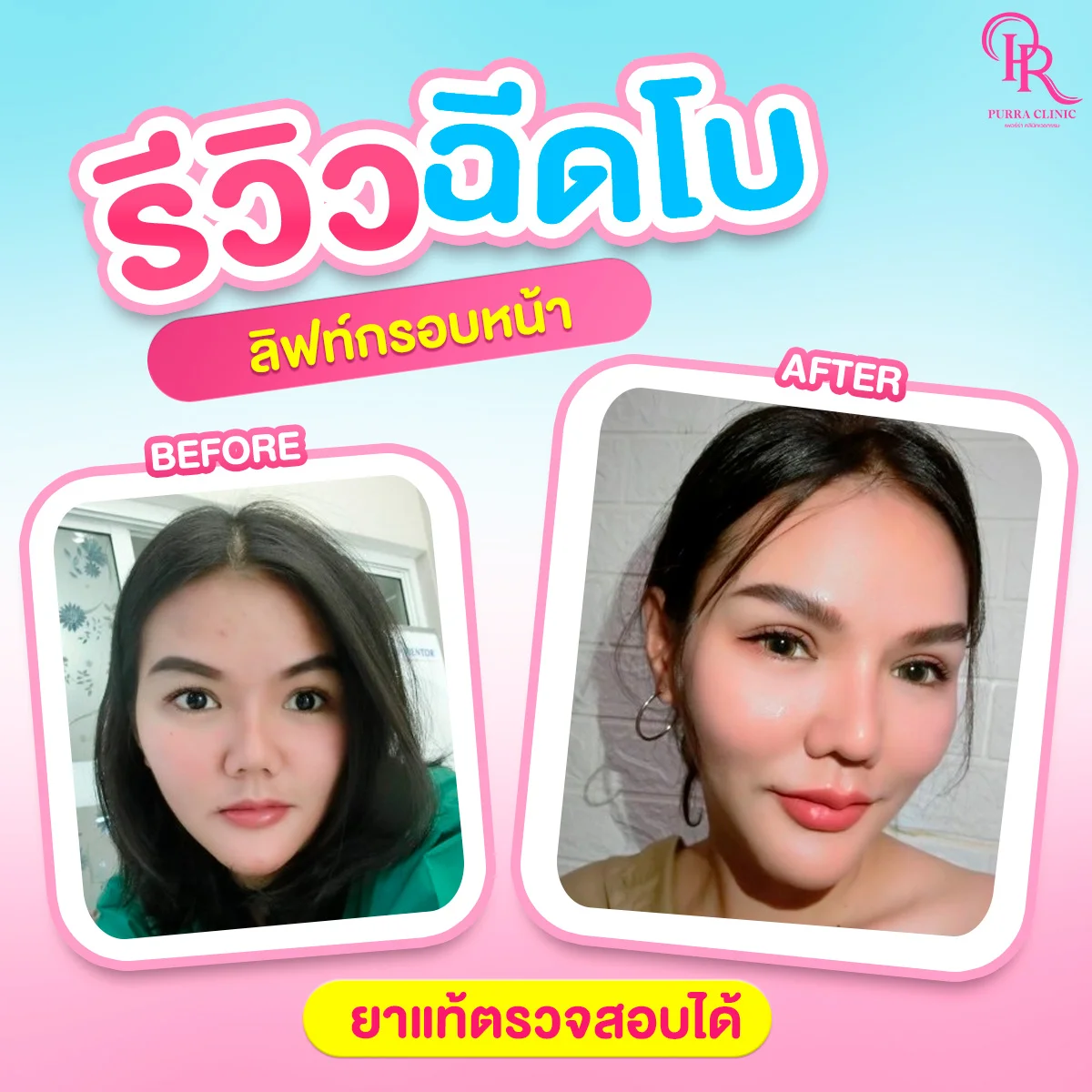 รีวิวลิฟกรอบหน้า