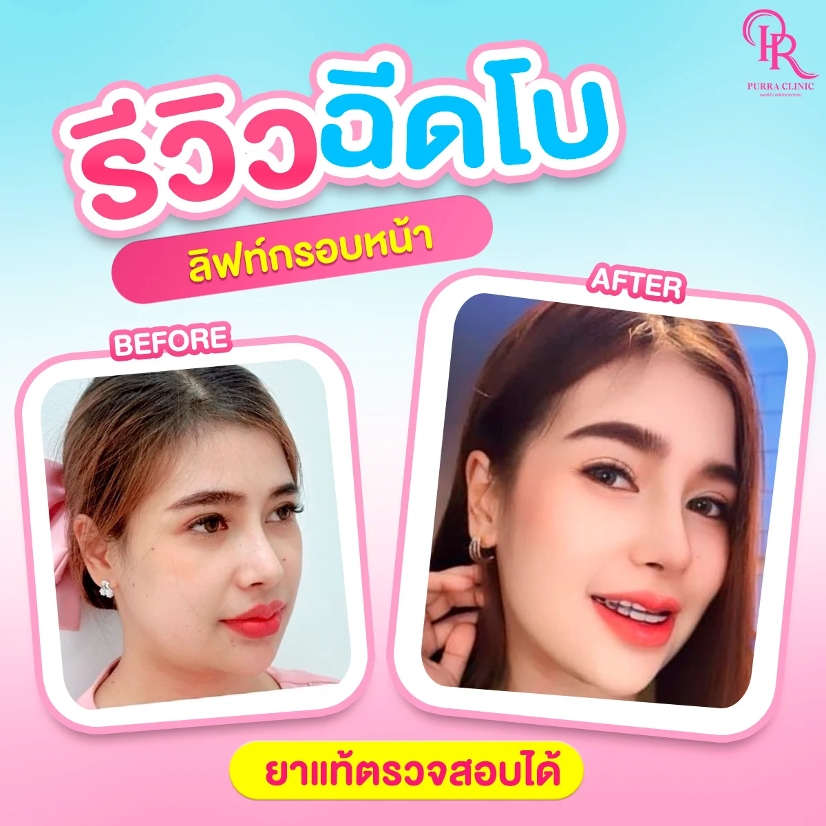 รีวิวลิฟกรอบหน้า