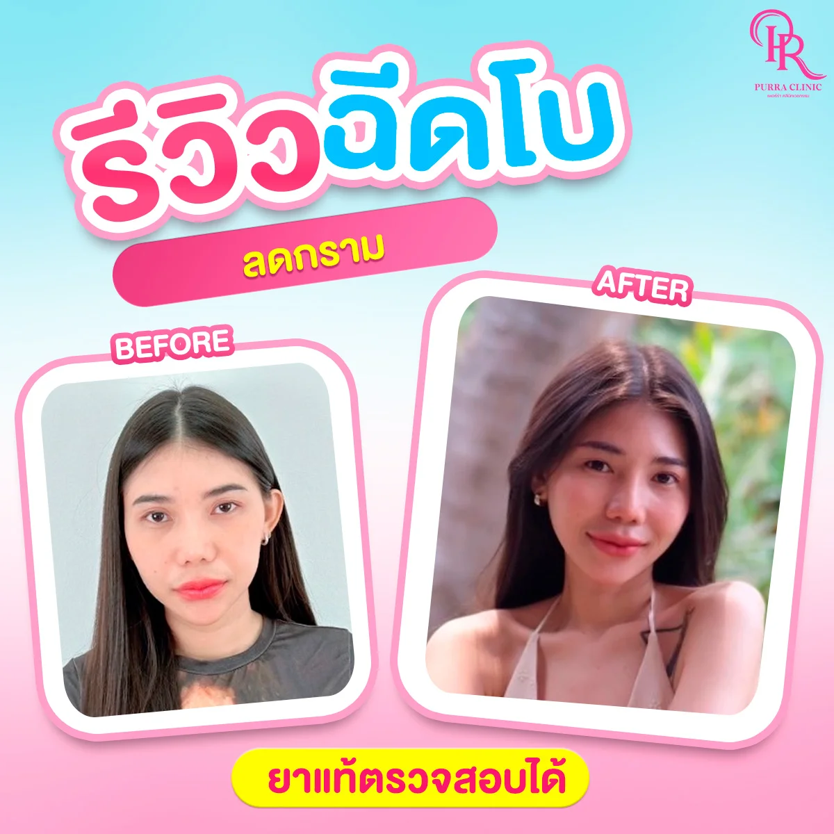 รีวิวโบท็อกซ์กราม