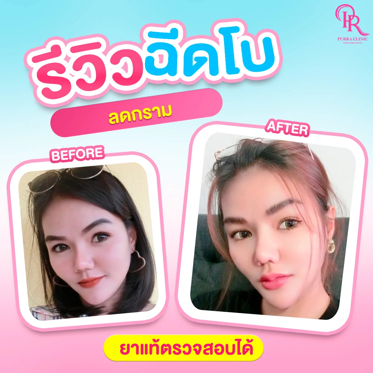 รีวิวโบท็อกซ์กราม