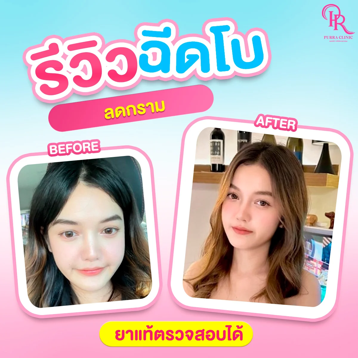 รีวิวโบท็อกซ์กราม