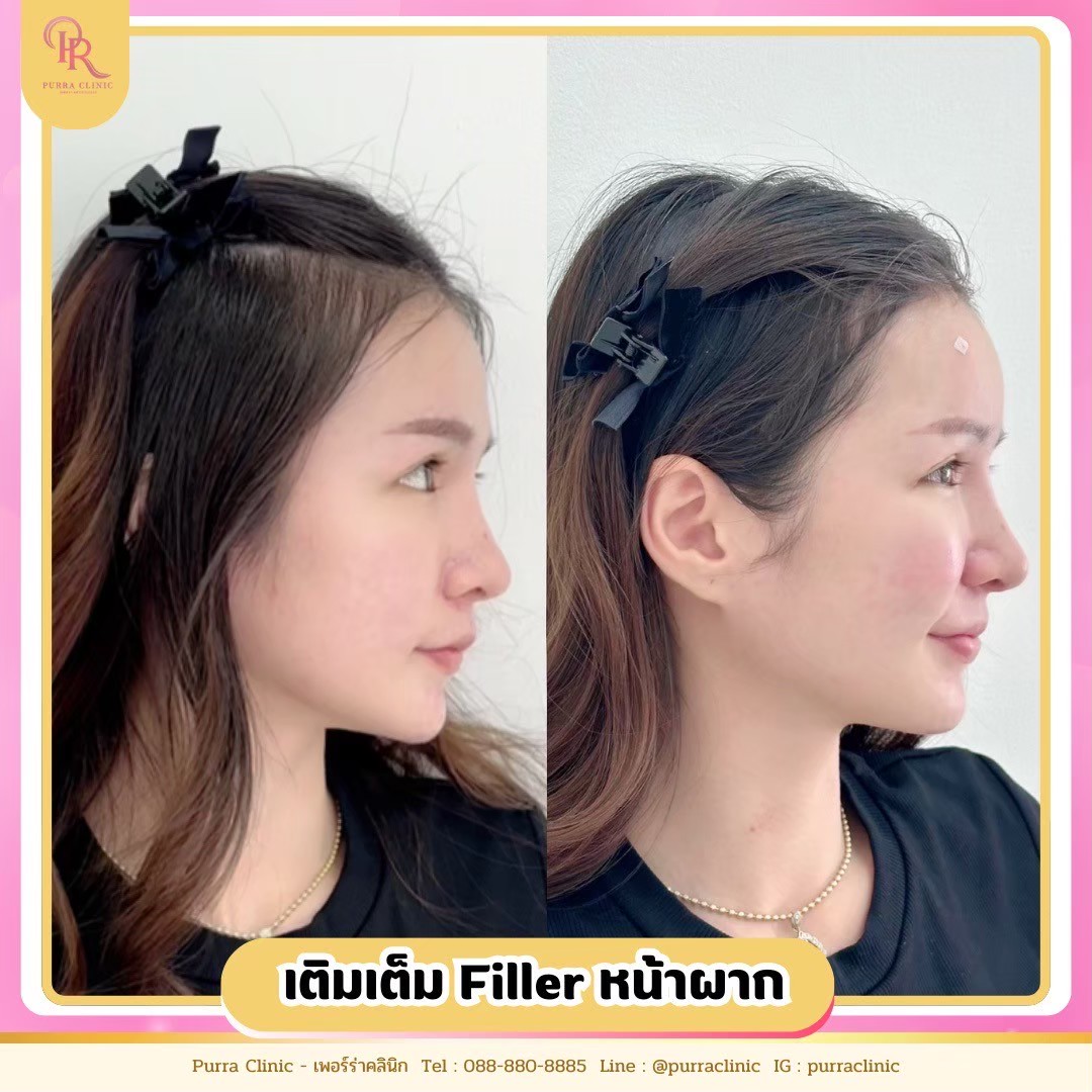 รีวิวฟิลเลอร์เติมหน้าผาก