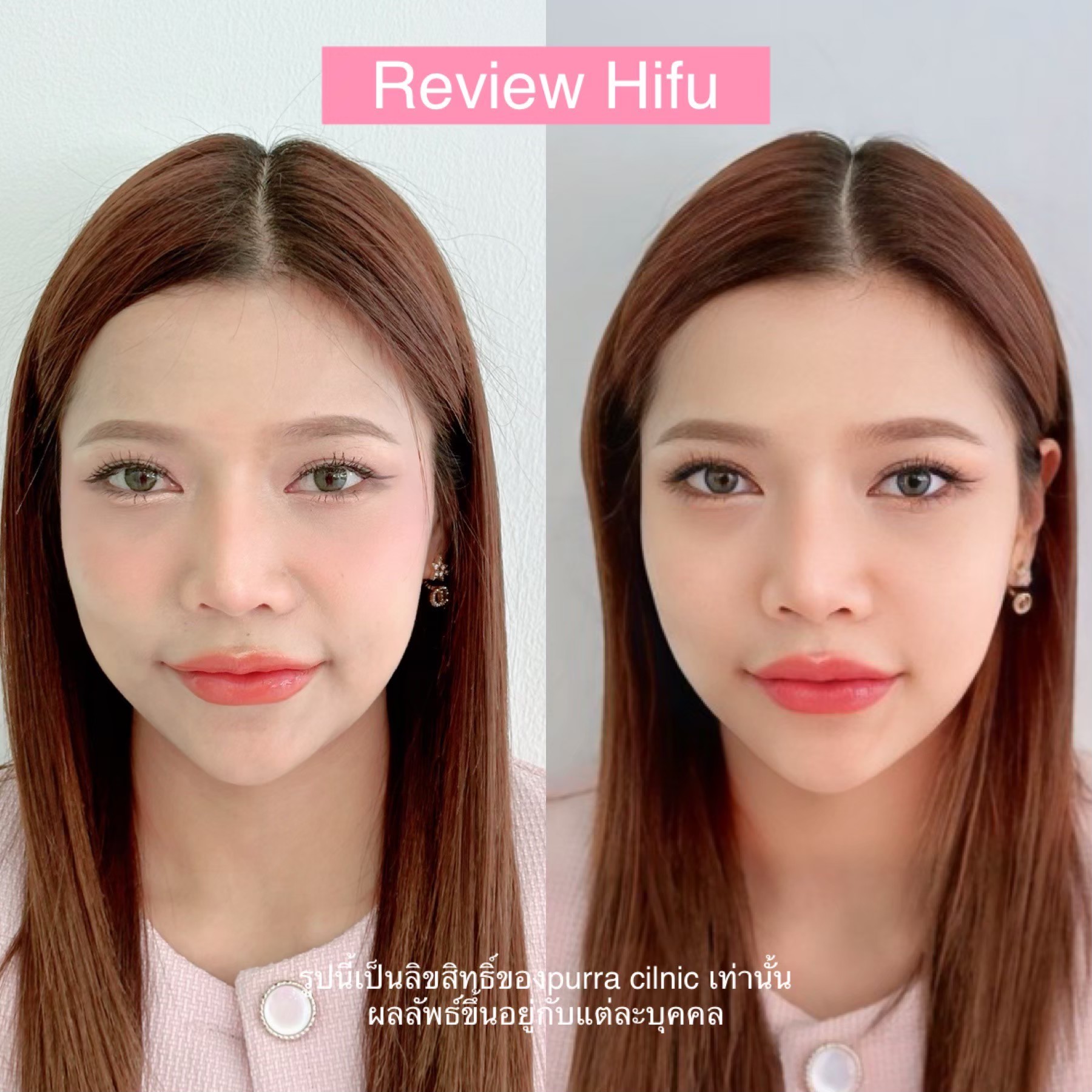 รีวิว Hifu
