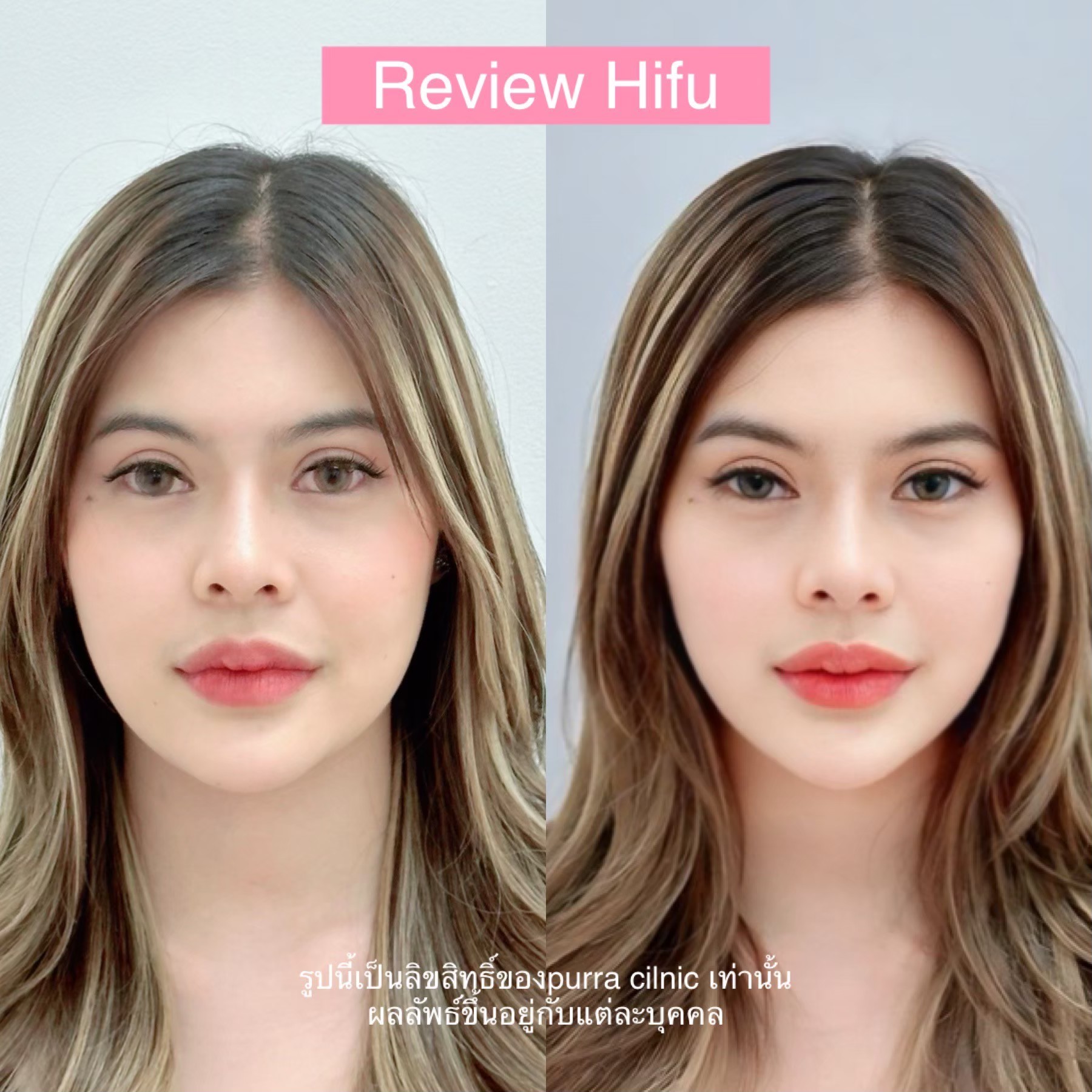 รีวิว Hifu