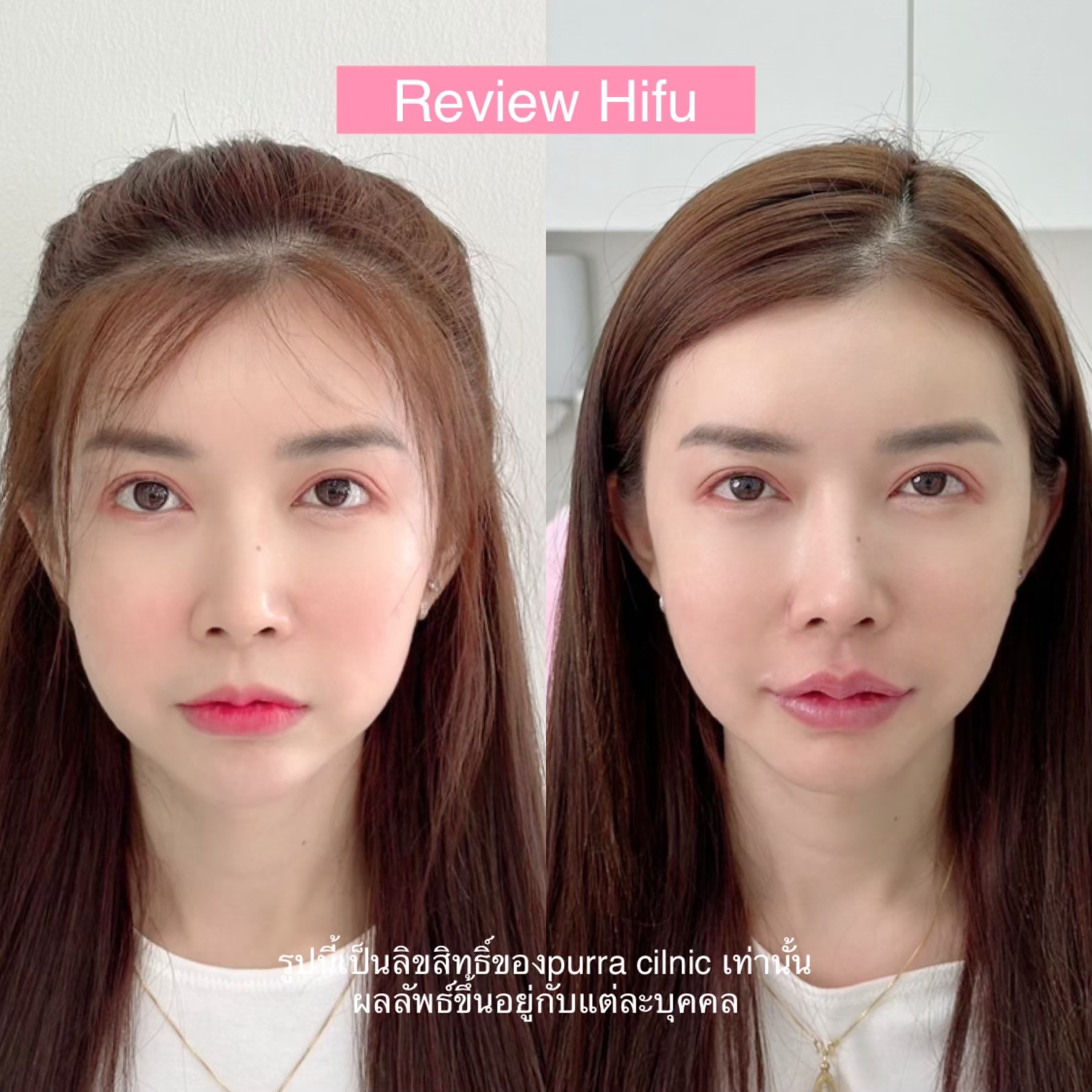 รีวิว Hifu