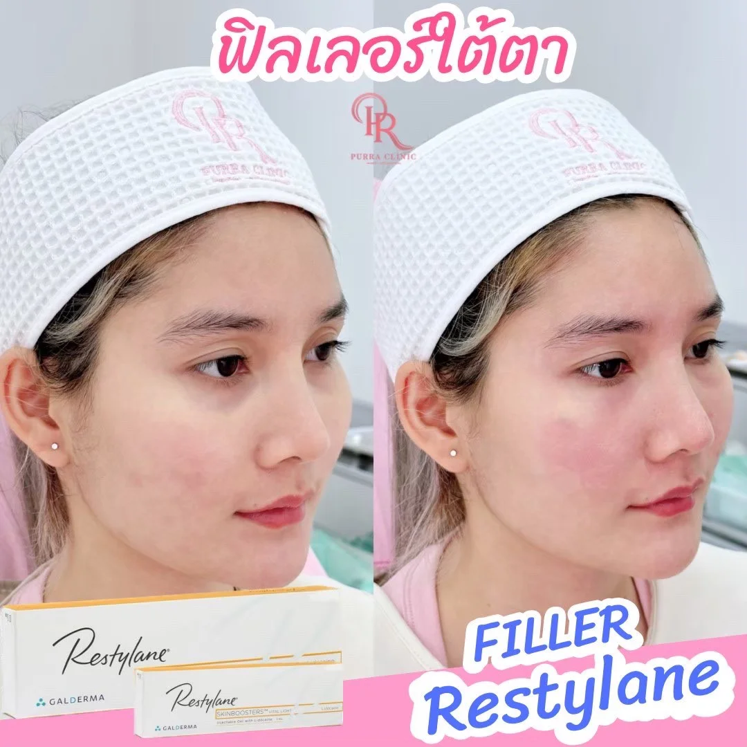 รีวิวฟิลเลอร์เติมใต้ตา