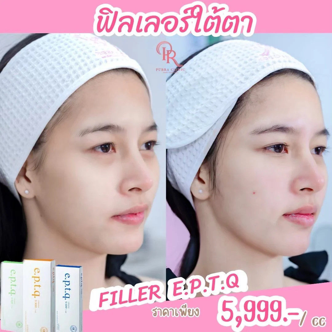 รีวิวฟิลเลอร์เติมใต้ตา