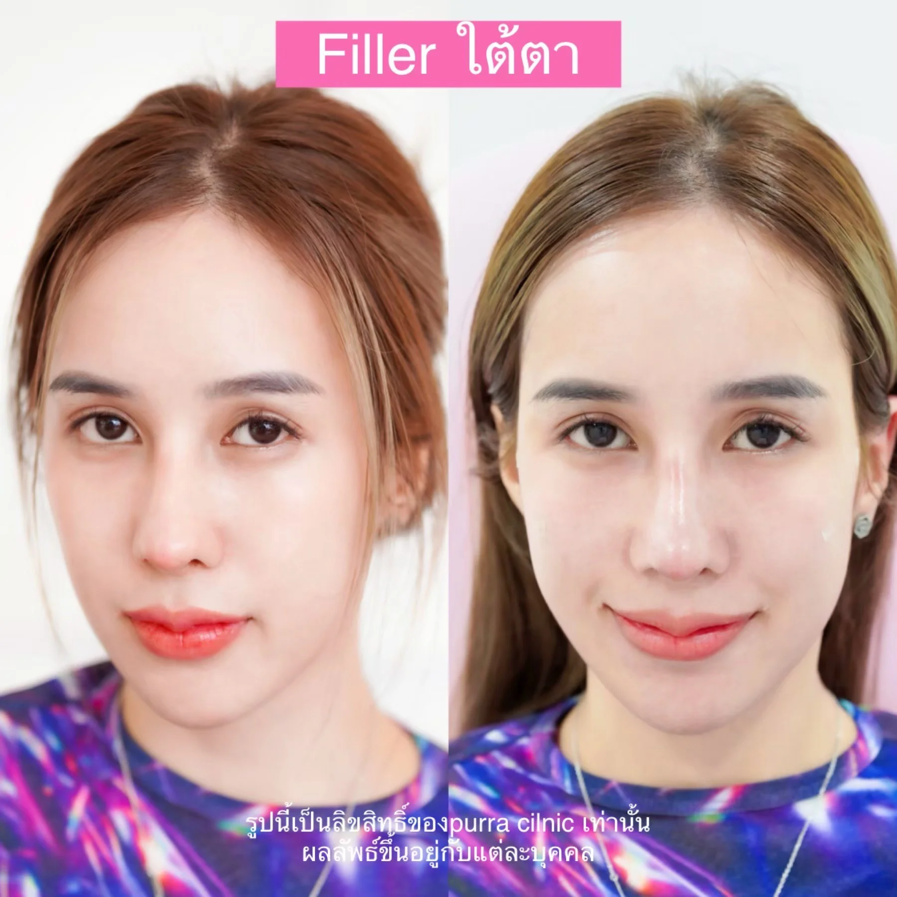 รีวิวฟิลเลอร์เติมใต้ตา