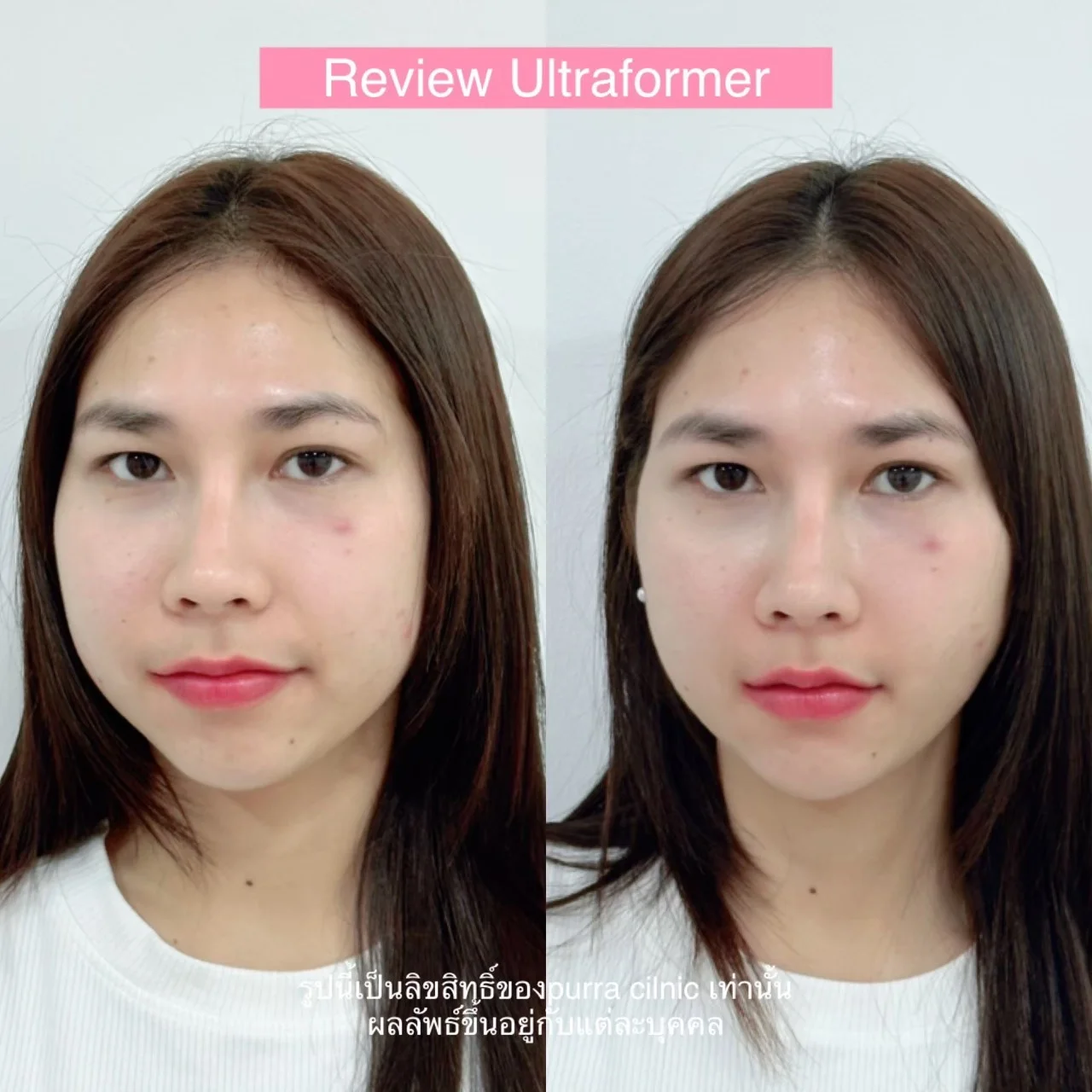 รีวิว Ultraformer