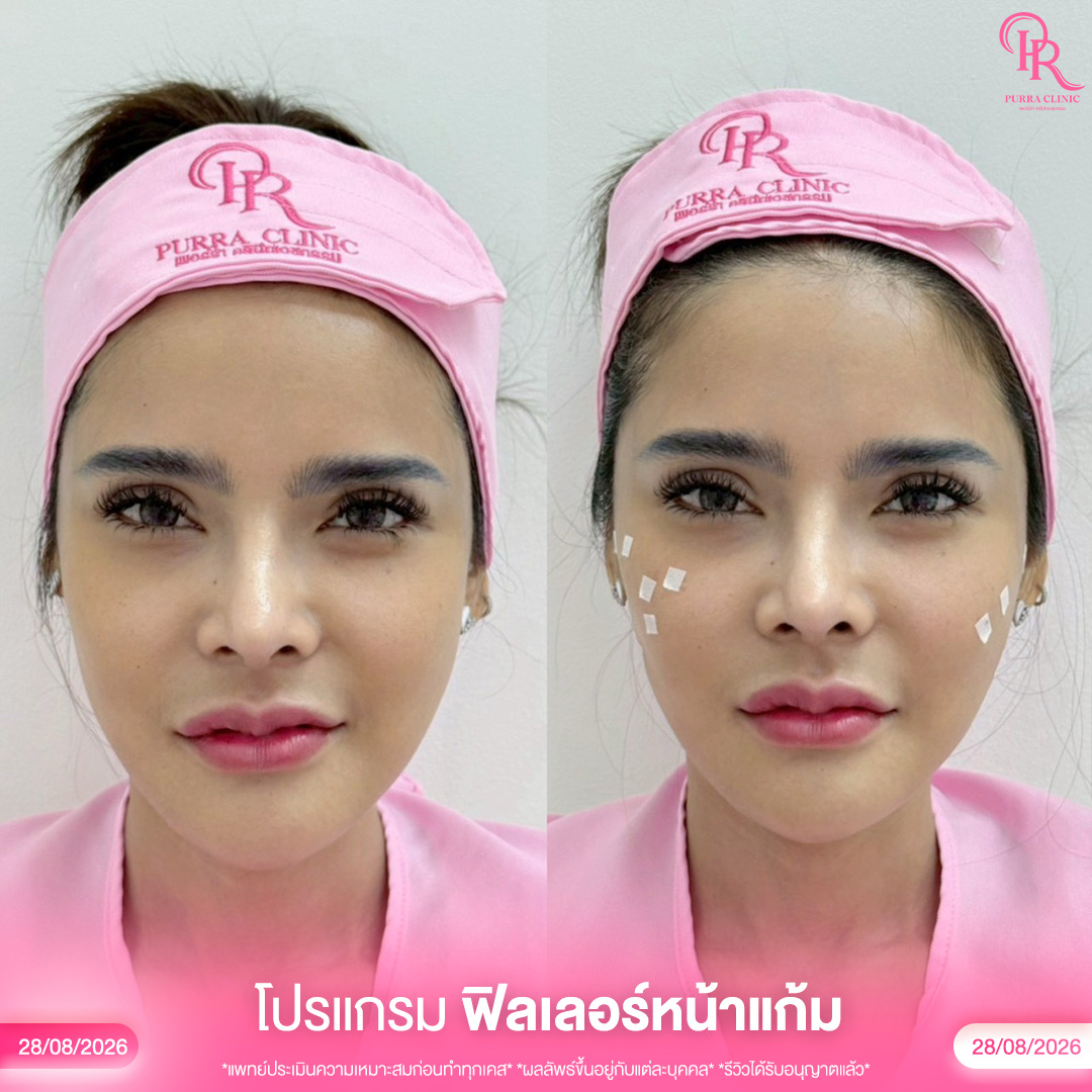 หน้าแก้ม 2_0