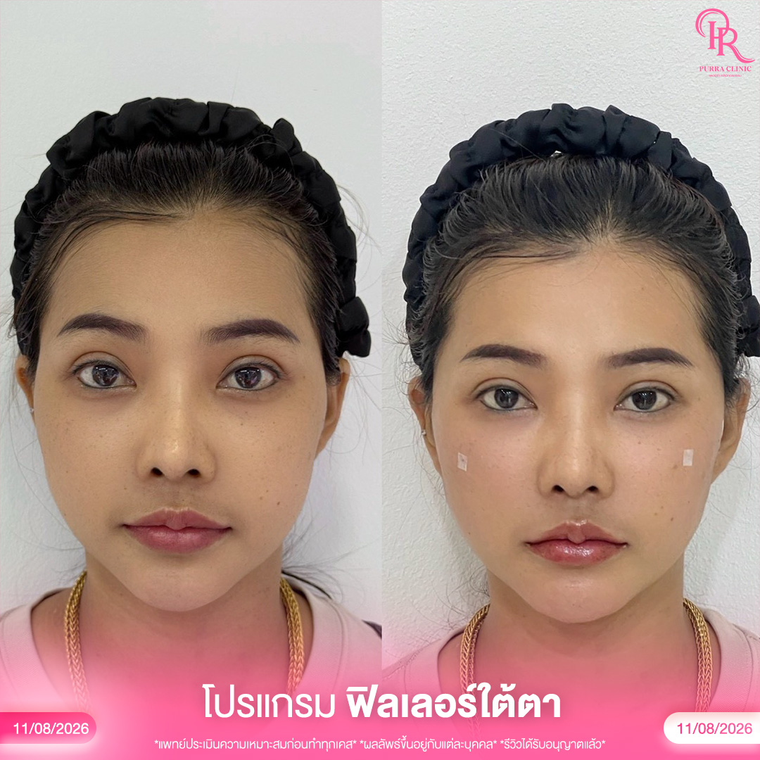 ใต้ตา 4_0