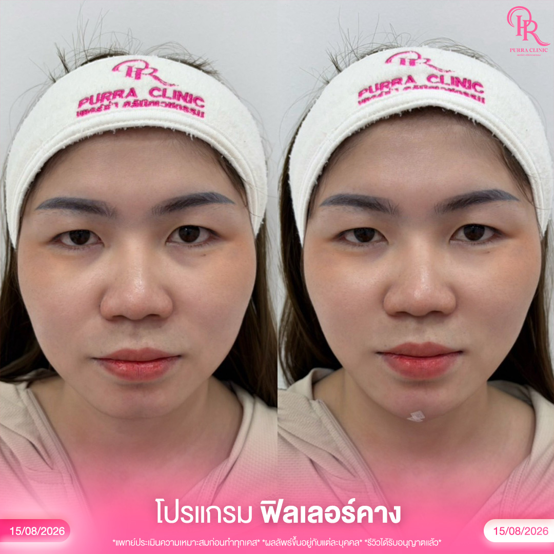 คาง 2_0