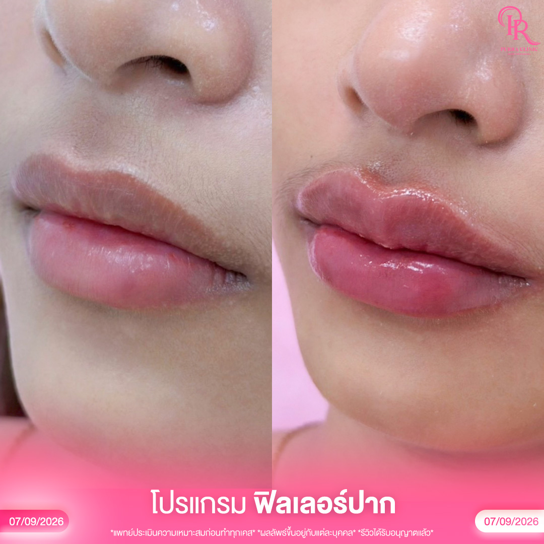 ฟิลเลอร์ 4_0