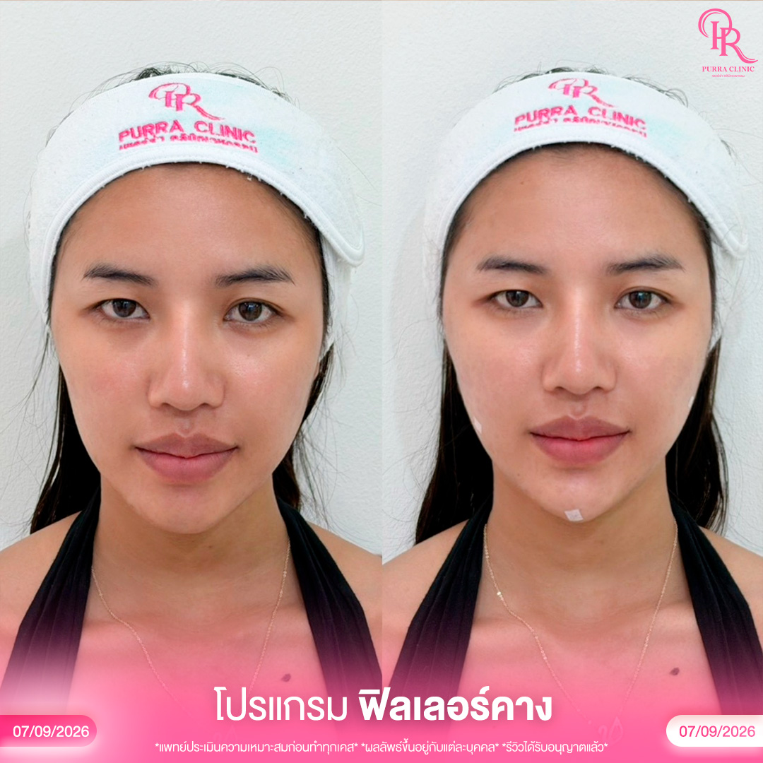 ฟิลเลอร์ 8_0