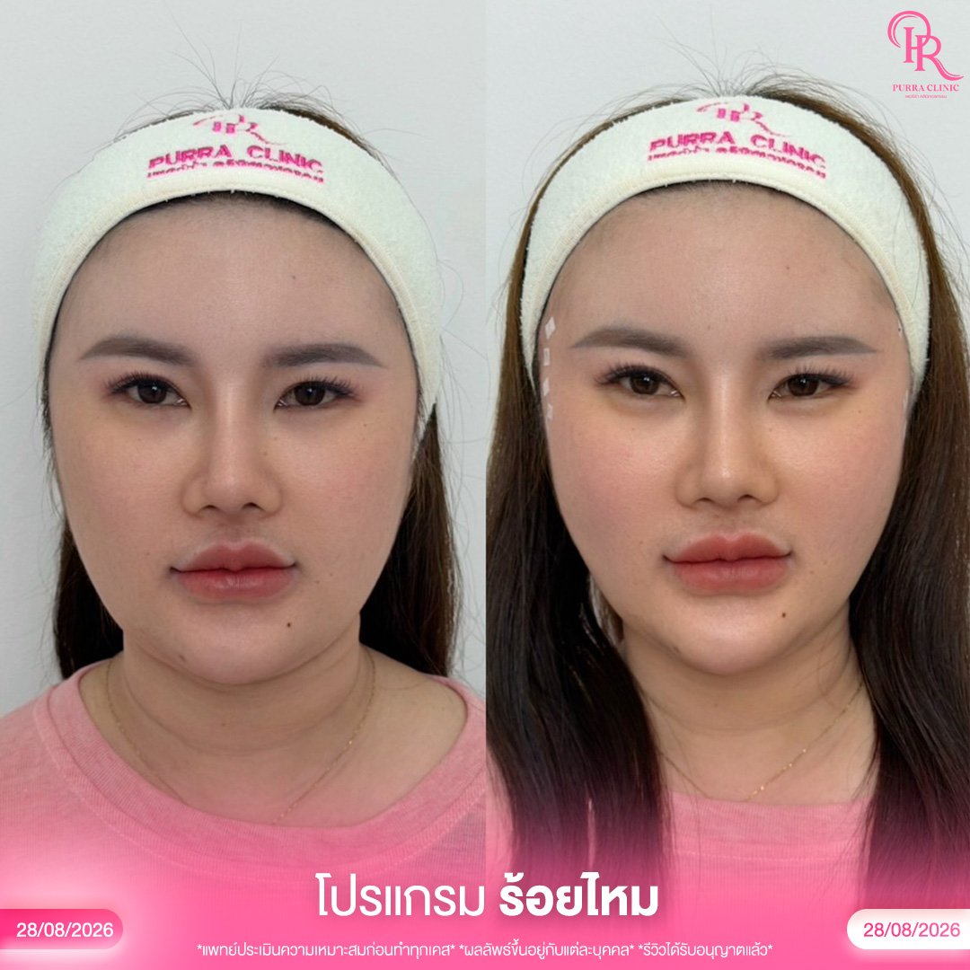 ร้อยไหม 1