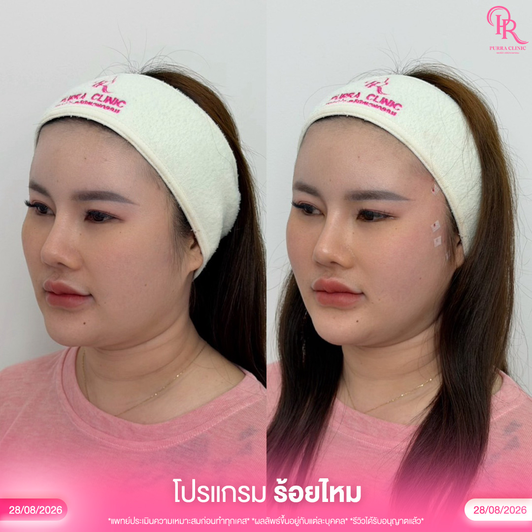 ร้อยไหม 2