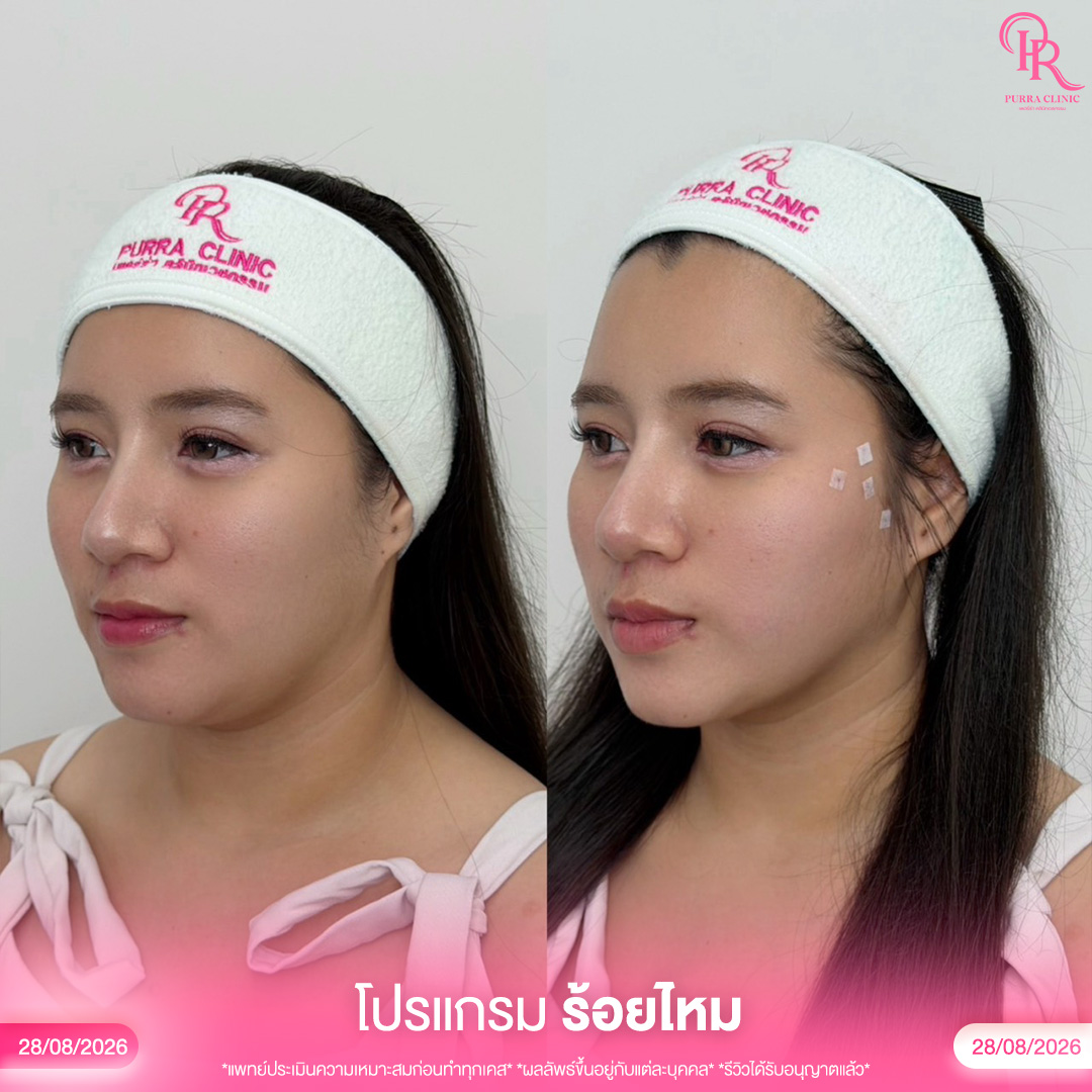 ร้อยไหม 3