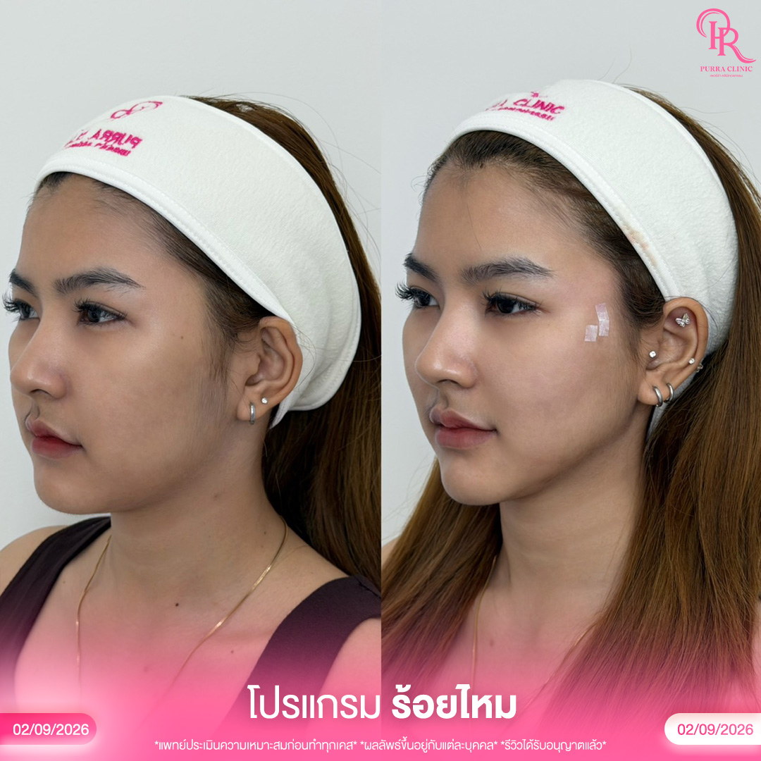 ร้อยไหม 3_0