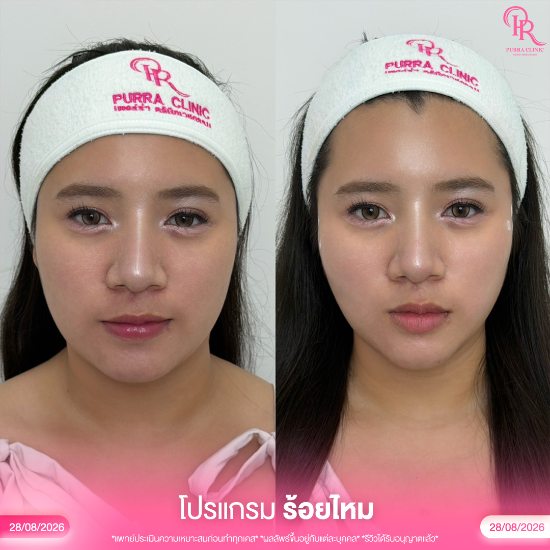 ร้อยไหม 4