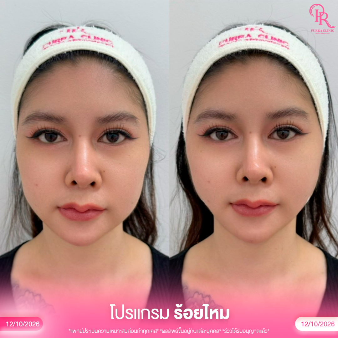ร้อยไหม 4