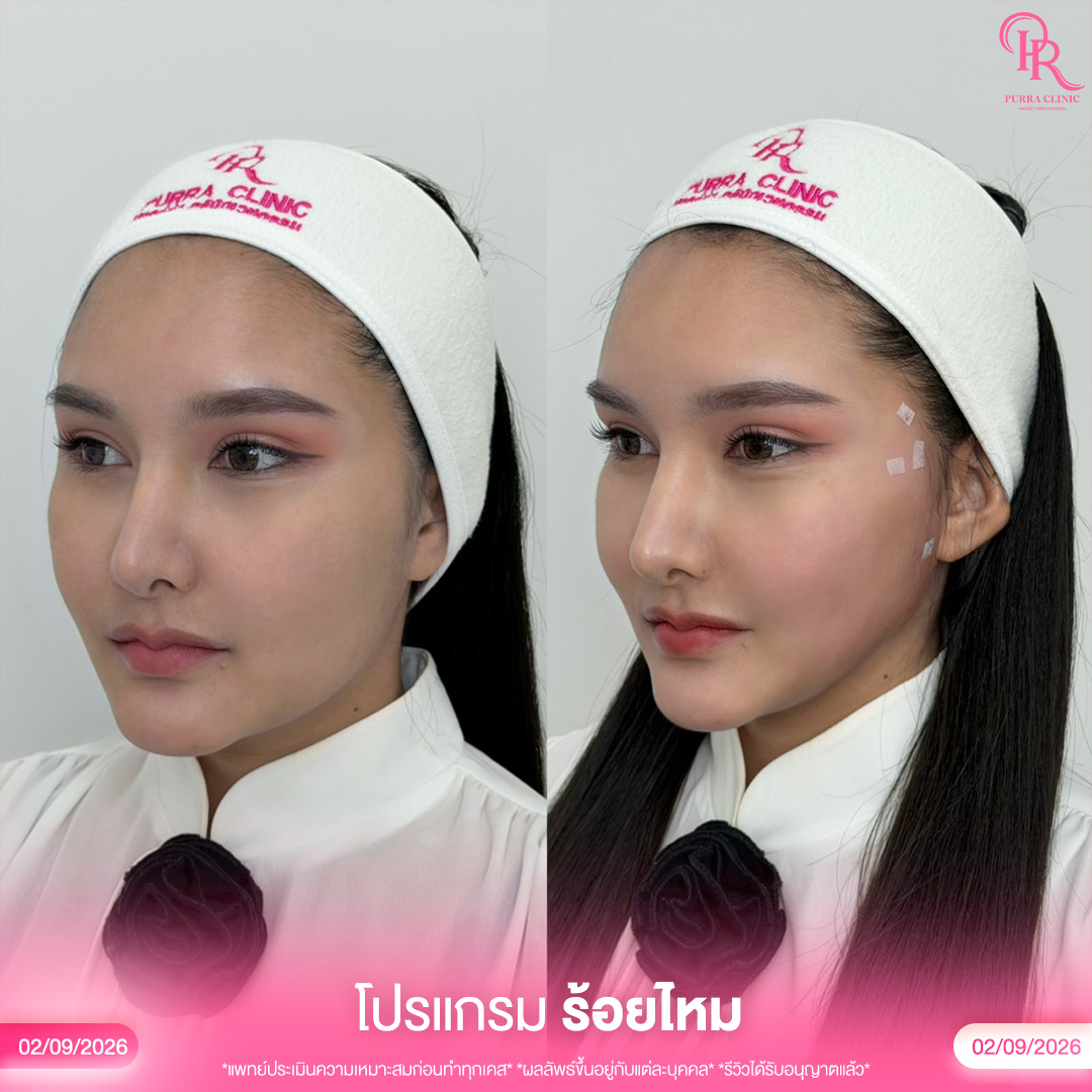 ร้อยไหม 5_0