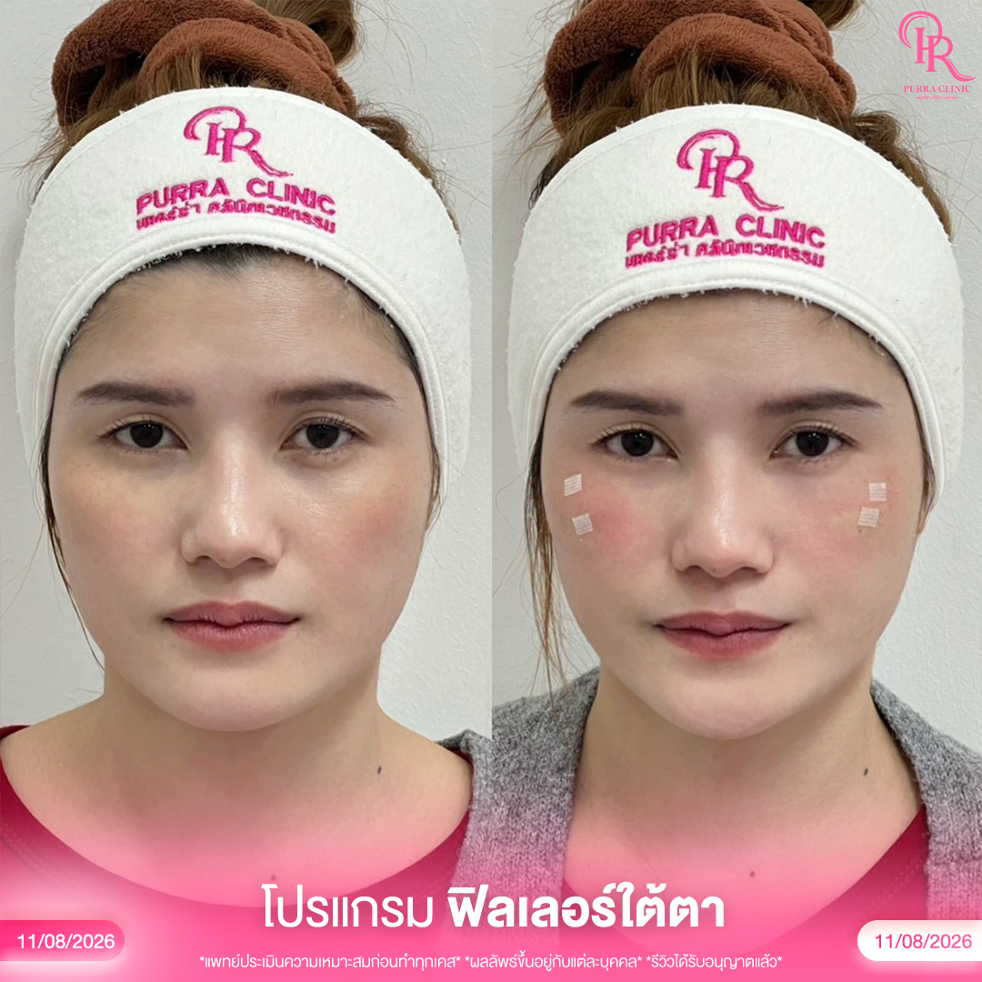 ใต้ตา 2_0