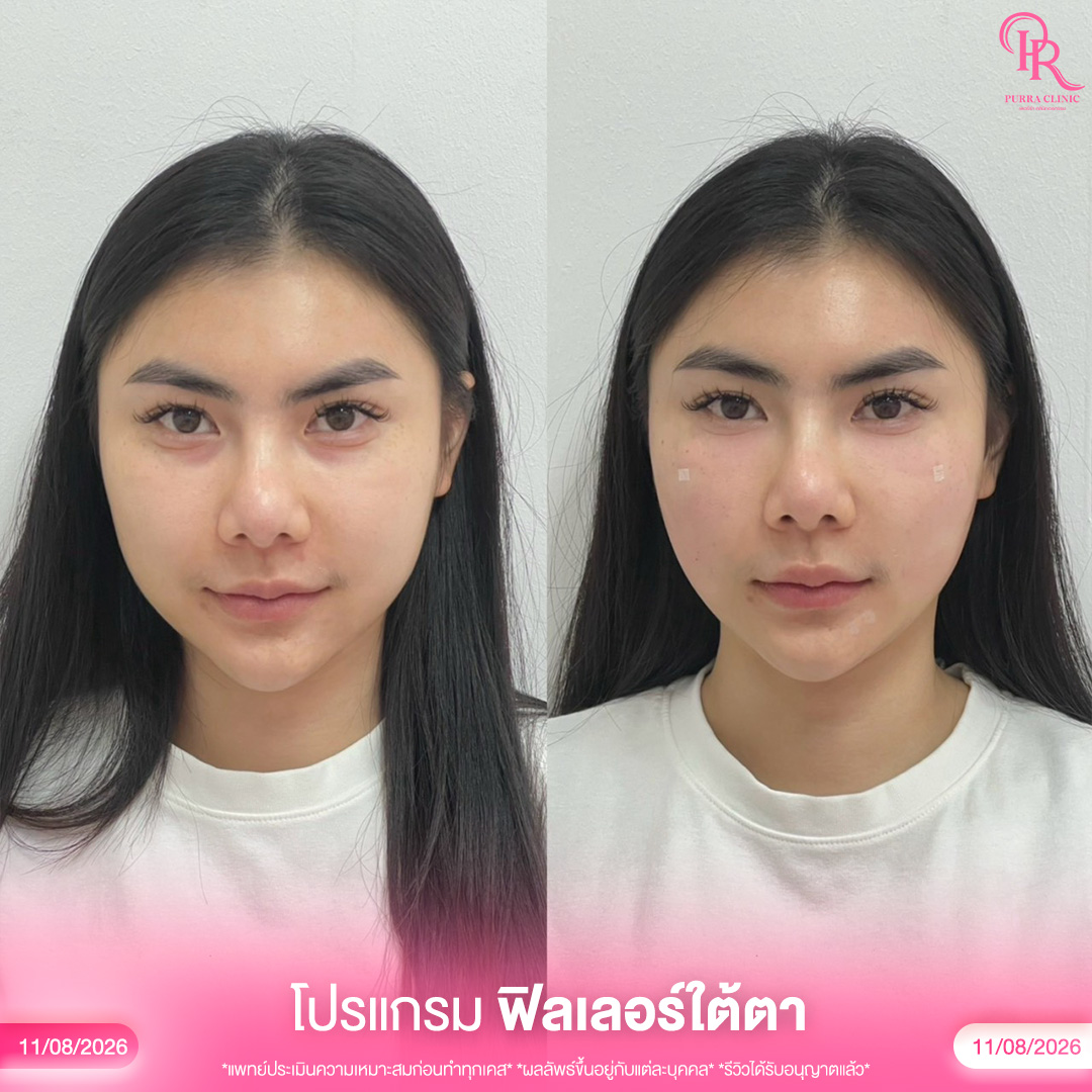 ใต้ตา 3_0