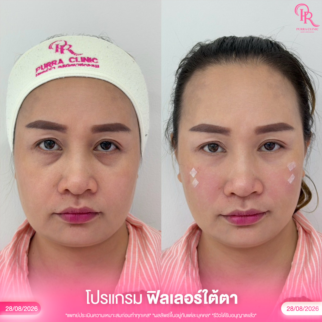 ใต้ตา