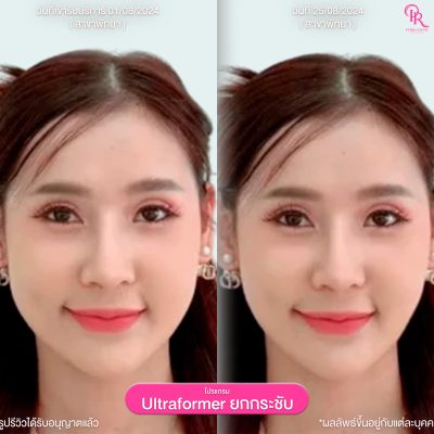 359 รีวิว Ultraformer ทุกคน 02_0