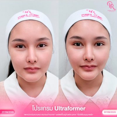 ultraformer 1